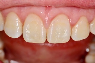 前歯の症例〜欠けた部分の治療〜