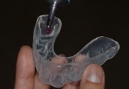 マウスピースによる歯周病治療