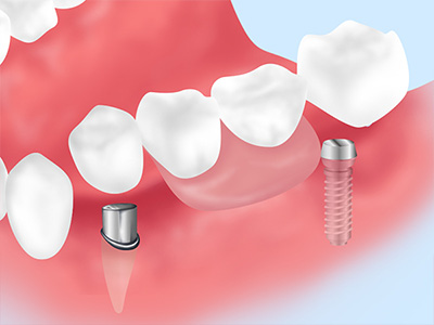 インプラントと義歯の併用