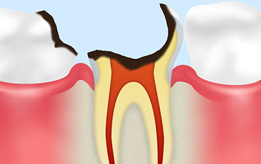 C4：歯根まで達した虫歯
